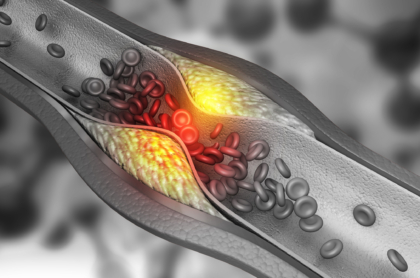 Artery blocked with bad cholesterol. clogged arteries, coronary artery plaque. 3d illustration