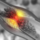 Artery blocked with bad cholesterol. clogged arteries, coronary artery plaque. 3d illustration